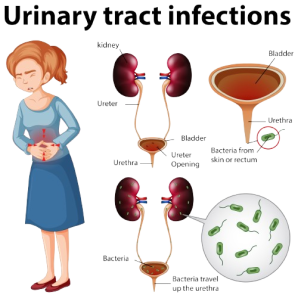 Urinary Tract Infection, STD